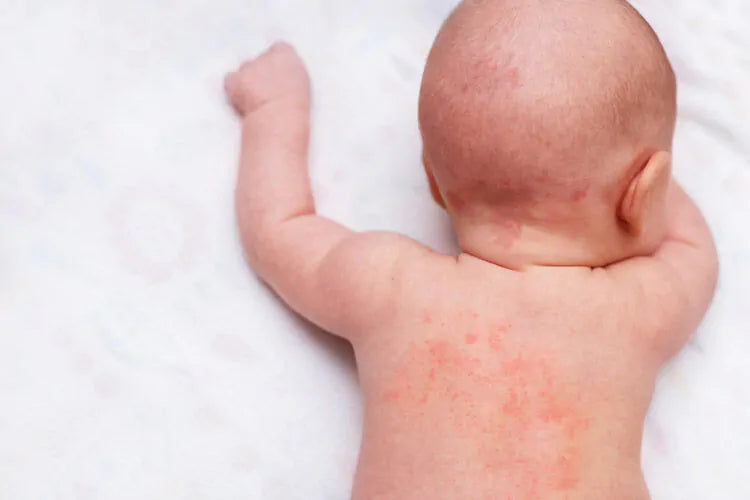 Baby Eczema Symptoms and Treatment